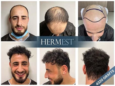 hermest hair transplant|best turkey hair transplant package.